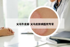 義烏牛皮癬 義烏皮膚病醫(yī)院專家