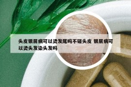 頭皮銀屑病可以燙發(fā)尾嗎不碰頭皮 銀屑病可以燙頭發(fā)染頭發(fā)嗎