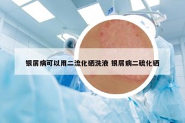 銀屑病可以用二流化硒洗液 銀屑病二硫化硒