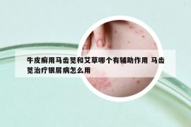 牛皮癬用馬齒莧和艾草哪個有輔助作用 馬齒莧治療銀屑病怎么用