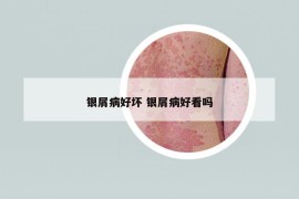 銀屑病好壞 銀屑病好看嗎