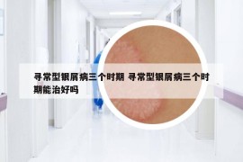 尋常型銀屑病三個時期 尋常型銀屑病三個時期能治好嗎