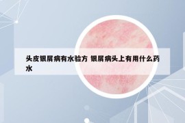 頭皮銀屑病有水驗方 銀屑病頭上有用什么藥水
