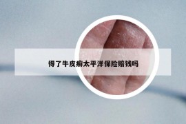 得了牛皮癬太平洋保險賠錢嗎