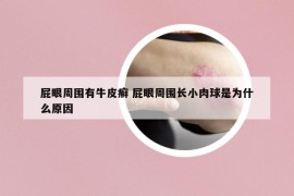 屁眼周圍有牛皮癬 屁眼周圍長小肉球是為什么原因