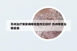 蘇州治療銀屑病哪家醫(yī)院比較好 蘇州哪里治銀屑病