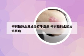 柳樹枝熬水洗澡治療牛皮癬 柳樹枝熬水能治銀屑病