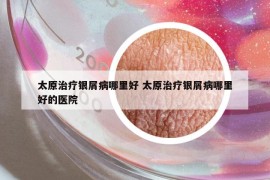 太原治療銀屑病哪里好 太原治療銀屑病哪里好的醫(yī)院