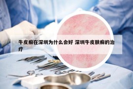 牛皮癬在深圳為什么會好 深圳牛皮膚癬的治療