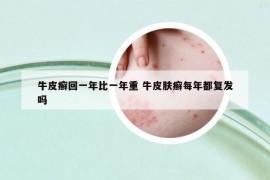 牛皮癬回一年比一年重 牛皮膚癬每年都復(fù)發(fā)嗎