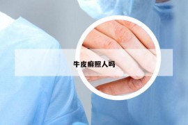 牛皮癬照人嗎