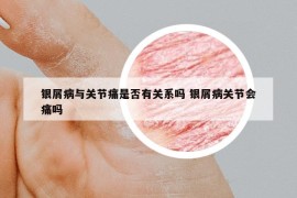銀屑病與關(guān)節(jié)痛是否有關(guān)系嗎 銀屑病關(guān)節(jié)會痛嗎