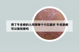 得了牛皮癬的人按摩哪個(gè)穴位最好 牛皮膚癬可以做按摩嗎