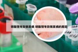 碳酸鋰導(dǎo)致銀屑病 碳酸鋰導(dǎo)致銀屑病的原因