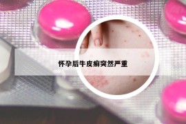 懷孕后牛皮癬突然嚴(yán)重