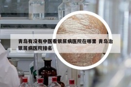 青島有沒有中醫(yī)看銀屑病醫(yī)院在哪里 青島治銀屑病醫(yī)院排名