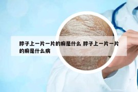 脖子上一片一片的癬是什么 脖子上一片一片的癬是什么病