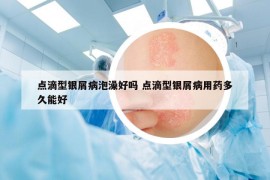 點滴型銀屑病泡澡好嗎 點滴型銀屑病用藥多久能好
