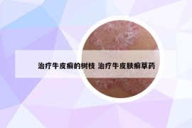 治療牛皮癬的樹枝 治療牛皮膚癬草藥