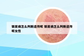 銀屑病怎么判斷遺傳呢 銀屑病怎么判斷遺傳呢女性