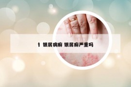 钅銀屑病癬 銀屑癬嚴(yán)重嗎
