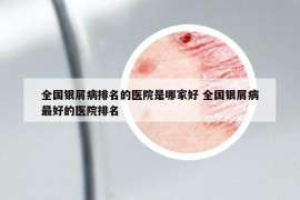 全國銀屑病排名的醫(yī)院是哪家好 全國銀屑病最好的醫(yī)院排名