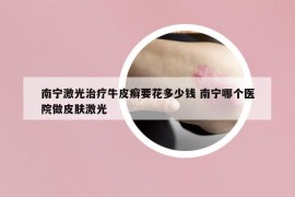 南寧激光治療牛皮癬要花多少錢 南寧哪個醫(yī)院做皮膚激光