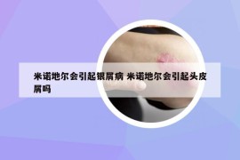米諾地爾會引起銀屑病 米諾地爾會引起頭皮屑嗎