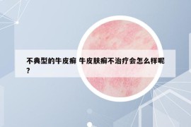 不典型的牛皮癬 牛皮膚癬不治療會怎么樣呢?