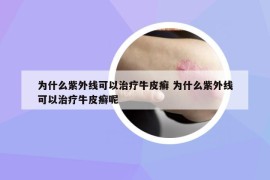 為什么紫外線可以治療牛皮癬 為什么紫外線可以治療牛皮癬呢