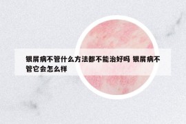 銀屑病不管什么方法都不能治好嗎 銀屑病不管它會怎么樣