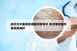 南京市中醫(yī)銀屑病醫(yī)院哪家好 南京哪所醫(yī)院看銀屑病好