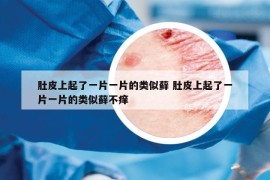 肚皮上起了一片一片的類似蘚 肚皮上起了一片一片的類似蘚不癢