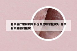 北京治療銀屑病?？漆t(yī)院是哪家醫(yī)院好 北京看銀屑病的醫(yī)院