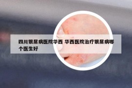 四川銀屑病醫(yī)院華西 華西醫(yī)院治療銀屑病哪個醫(yī)生好