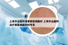 上海華山醫(yī)院誰(shuí)看銀屑病最好 上海華山醫(yī)院治療銀屑病最好的專(zhuān)家