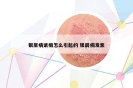 銀屑病紫癜怎么引起的 銀屑病發(fā)紫