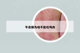 牛皮癬為啥不能吃雞肉