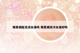 銀屑病能洗涼水澡嗎 銀屑病洗冷水澡好嗎
