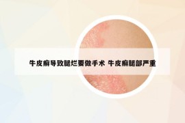 牛皮癬導致腿爛要做手術(shù) 牛皮癬腿部嚴重