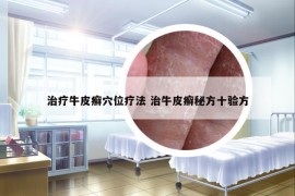 治療牛皮癬穴位療法 治牛皮癬秘方十驗方