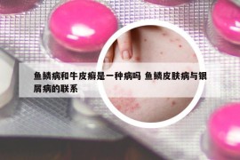 魚鱗病和牛皮癬是一種病嗎 魚鱗皮膚病與銀屑病的聯(lián)系