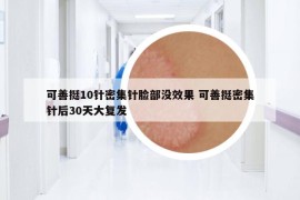 可善挺10針密集針臉部沒效果 可善挺密集針后30天大復(fù)發(fā)