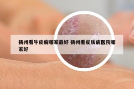 揚(yáng)州看牛皮癬哪家最好 揚(yáng)州看皮膚病醫(yī)院哪家好