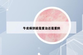 牛皮癬到底是重治還是重防
