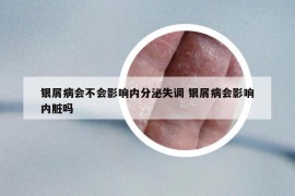 銀屑病會(huì)不會(huì)影響內(nèi)分泌失調(diào) 銀屑病會(huì)影響內(nèi)臟嗎