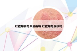 紅疙瘩會(huì)是牛皮癬嘛 紅疙瘩是皮疹嗎