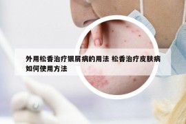 外用松香治療銀屑病的用法 松香治療皮膚病如何使用方法