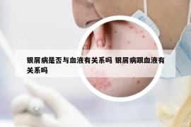 銀屑病是否與血液有關(guān)系嗎 銀屑病跟血液有關(guān)系嗎