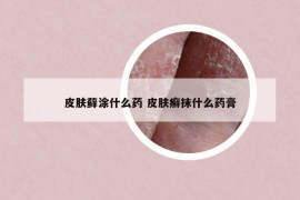 皮膚蘚涂什么藥 皮膚癬抹什么藥膏